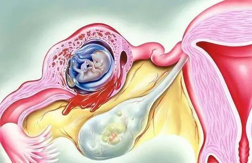 什么是卵巢过度综合征，对试管婴儿有什么影响